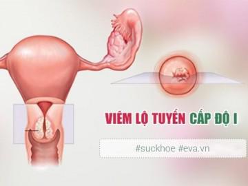 Khí hư bất thường, cẩn thận kẻo mắc viêm lộ tuyến cổ tử cung độ 1