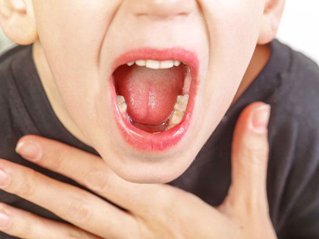 Bác sĩ vạch rõ sai lầm của cha mẹ khi trị viêm họng tại nhà khiến con nặng bệnh