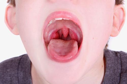 Trẻ bị viêm amidan khi nào cần phải phẫu thuật? - 3