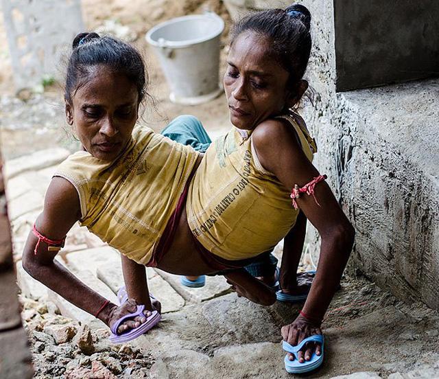 chuyen tinh ky la cua cap chi em song sinh dinh lien than cung yeu mot chang trai - 1