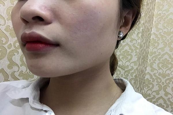 chieu long ban trai dung kem tron, co gai nay da mat 2 nam de phuc hoi da cua minh - 1