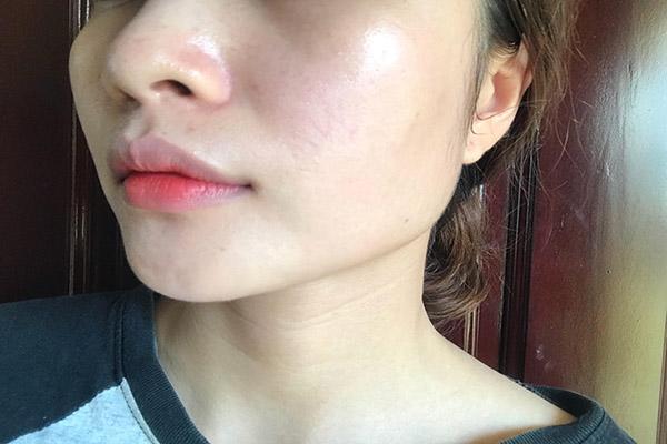 chieu long ban trai dung kem tron, co gai nay da mat 2 nam de phuc hoi da cua minh - 2