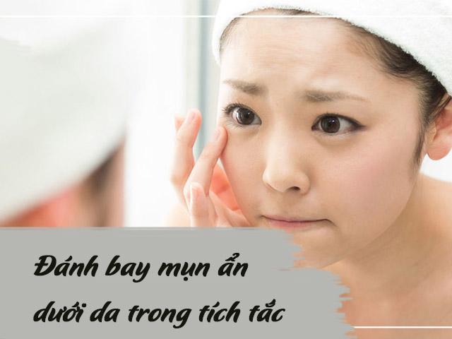 6 cách trị mụn ẩn dưới da nhanh, gọn và quan trọng nhất là chả tốn nhiều tiền