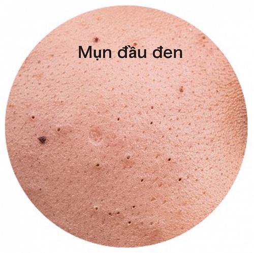 nhung cach tri mun dau den bang chanh vua nhanh vua don gian, lai vo cung hieu qua - 1