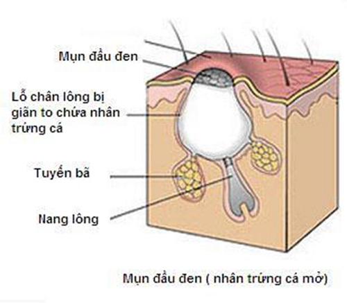 nhung cach tri mun dau den bang chanh vua nhanh vua don gian, lai vo cung hieu qua - 2