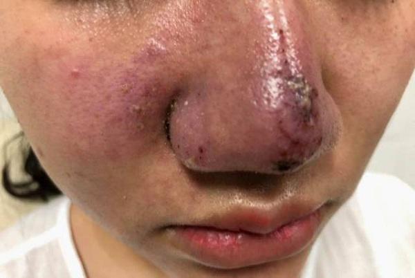 canh bao: lai co them 1 phu nu meo mat, mui boc mu vi tiem filler lam dep! - 1