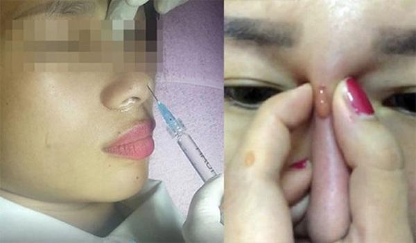 canh bao: lai co them 1 phu nu meo mat, mui boc mu vi tiem filler lam dep! - 3
