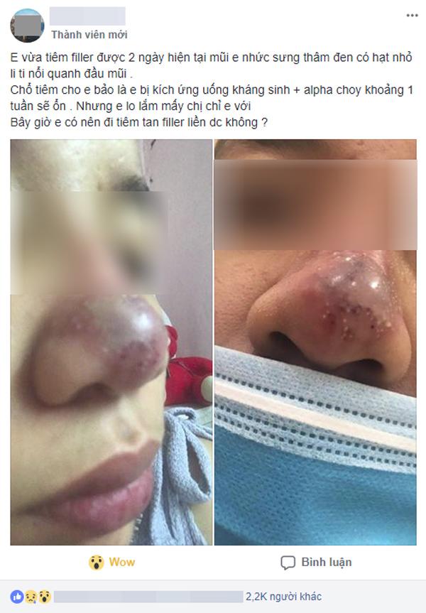 canh bao: lai co them 1 phu nu meo mat, mui boc mu vi tiem filler lam dep! - 4