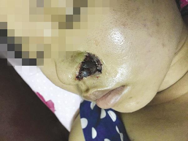 canh bao: lai co them 1 phu nu meo mat, mui boc mu vi tiem filler lam dep! - 2