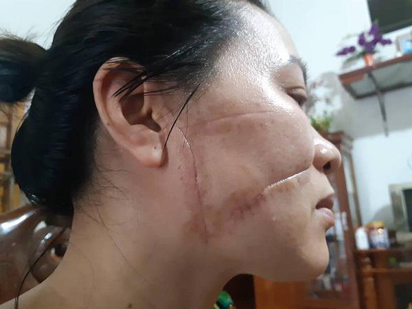 tin tuc 24h: noi cay dang cua nguoi vo bi chong rach mat, cat gan chan vi cuong ghen - 1