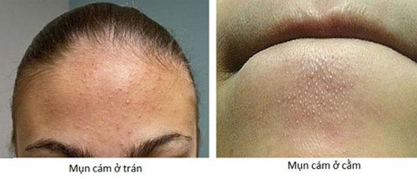 bo tui cac tuyet chieu tri mun cam don gian khong ngo xoa tan di noi lo cua ban - 2