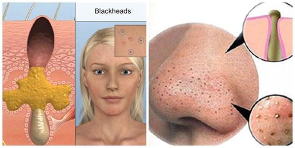 bo tui cac tuyet chieu tri mun cam don gian khong ngo xoa tan di noi lo cua ban - 1