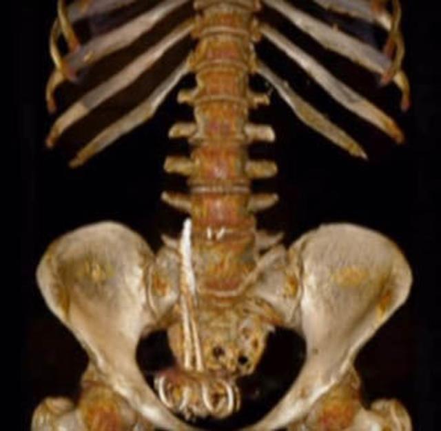 tuong bi ung thu, nao ngo la cay keo dai 15cm nam trong bung suot 6 thang - 2