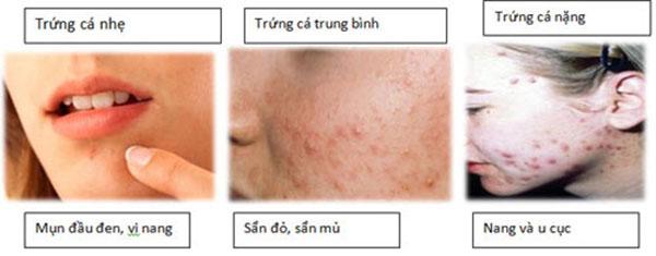 hoc ngay 8 cach tri mun trung ca don gian ma hieu qua khong ngo - 2