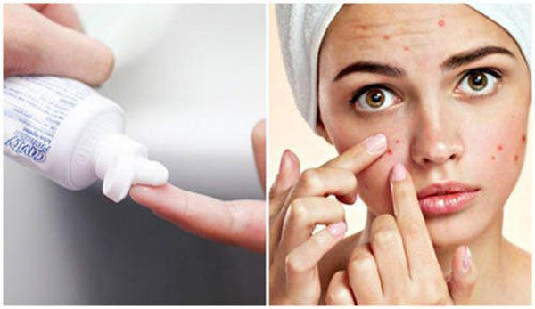 hoc ngay 8 cach tri mun trung ca don gian ma hieu qua khong ngo - 5