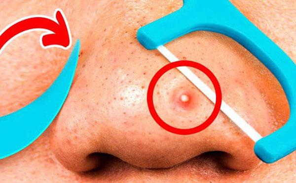 hoc ngay 8 cach tri mun trung ca don gian ma hieu qua khong ngo - 1