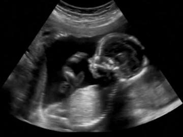 Bác sĩ nói nhau thai có nhiều chấm đen bí ẩn, mẹ bầu bất ngờ khi nghe nguyên nhân