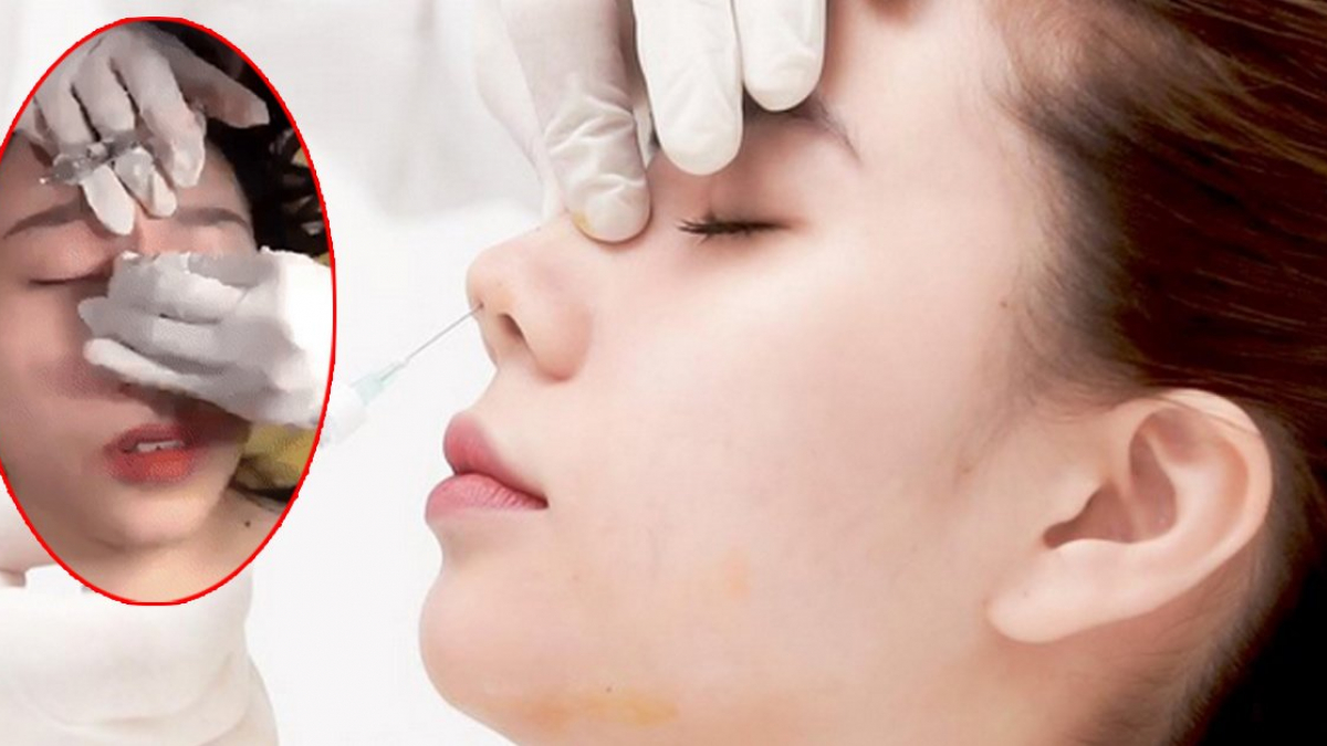 Sốc trước cảnh tiêm filler mũi thô bạo, chị em bao giờ mới thôi tin vào  thẩm mỹ giá rẻ?