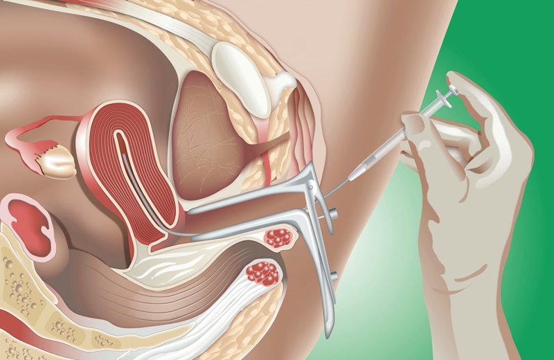 Thụ tinh nhân tạo bằng phương pháp bơm tinh trùng vào buồng tử cung (IUI) là phương pháp điều trị vô sinh đầu tay và được áp dụng từ lâu. 
