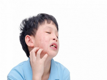 Trẻ bị quai bị: Bác sĩ chỉ rõ dấu hiệu nhận biết và cách phòng ngừa hiệu quả
