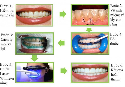 Tẩy trắng răng và những lưu ý cần biết về làm trắng răng tại nhà