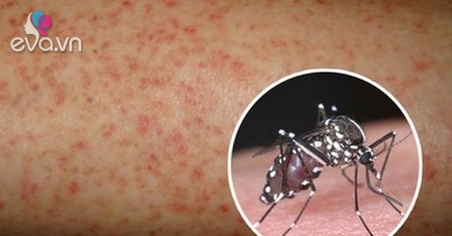 Khi bị sốt xuất huyết nên làm gì và ăn uống thế nào để ...