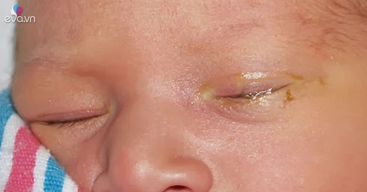 Trẻ sơ sinh bị đau mắt phải chữa trị tại nhà như thế nào?