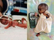 Bé gái sinh ra chỉ nặng 3 lạng, bé bằng chiếc điện thoại sau 16 năm giờ ra sao?