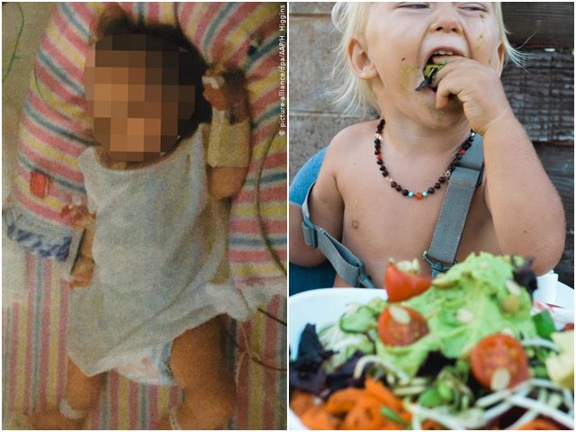 Bé gái bị suy dinh dưỡng, không thể nói hay ngồi vì cha mẹ cho ăn chay suốt 19 tháng