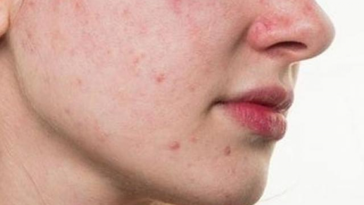 Phải làm gì khi da mặt sần sùi khiến bạn mất tự tin?