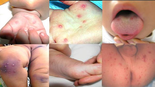 Bệnh tay chân miệng ở trẻ em: Biểu hiện, dấu hiệu, hình ảnh nhận biết - 3