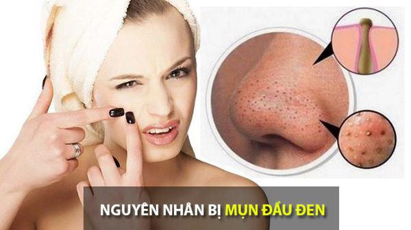 Kết quả hình ảnh cho Trị mụn đầu đen hiệu quả