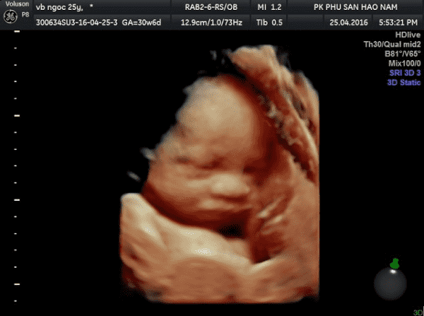 Tìm hiểu hình ảnh siêu âm thai đôi 4 tuần và các dấu hiệu nhận biết sớm sự  phát triển của thai nhi