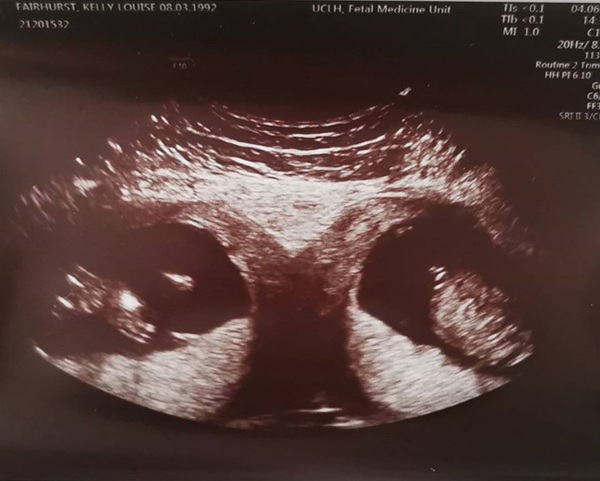 Song thai giống hệt nhau: Những bức ảnh sẽ khiến bạn cảm thấy ngạc nhiên và thích thú khi nhìn thấy sự giống hệt giữa hai em bé song sinh. Hãy cùng nhau khám phá cơ thể của hai chú tiểu và thưởng thức vẻ đẹp độc đáo của cặp song sinh đáng yêu này.