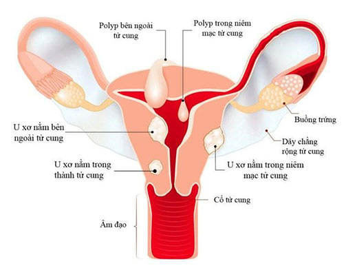 U nang và việc thụ thai - U nang buồng trứng là tình trạng rất phổ biến ở phụ nữ và có thể ảnh hưởng đến khả năng thụ thai. Tuy nhiên, với sự can thiệp phù hợp và kế hoạch sinh sản hợp lý, phụ nữ vẫn có thể thụ thai và mang thai. Hãy cùng xem hình ảnh để biết thêm thông tin về u nang buồng trứng và cách thích ứng để có thể thụ thai thành công.