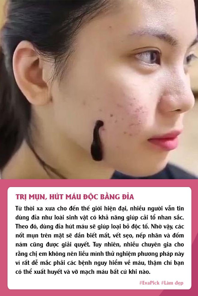 Phương pháp làm đẹp độc lạ vẫn được chị em áp dụng: đắp mask phân chim, dùng đỉa hút mụn - 5