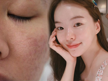 Bạn đang làm những việc khiến lỗ chân lông nở toang hoác mỗi ngày, dừng ngay còn kịp