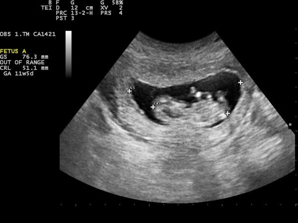 Siêu âm thai: Hãy khám phá những hình ảnh tuyệt đẹp của thai nhi thông qua siêu âm thai. Với độ chính xác và độ phân giải cao, bạn sẽ có những trải nghiệm tuyệt vời khi được quan sát tình trạng sức khỏe của bé yêu trong bụng mẹ.