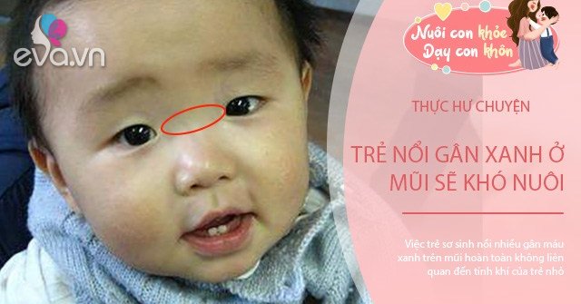 Thực hư chuyện trẻ nổi gân xanh ở mũi sẽ khó nuôi, khoa học giải thích - Vimarsana News