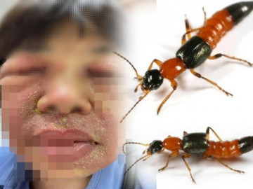 Bị kiến ba khoang đốt, tuyệt đối tránh làm việc này nếu không muốn người lở loét, mặt nở hoa - Vimarsana News