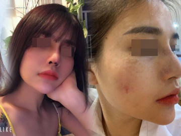 Hành trình làm đẹp 5 năm xót ví của mẹ 2 con: thủng mũi, áp-xe má, đau nhất chữa nám - Vimarsana News