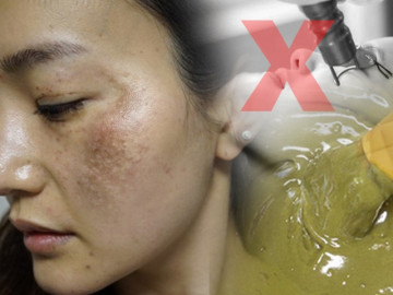 Rẻ-Đẹp-Dễ: Việt Nam may mắn có 1 loại lá chuyên trị nám, tìm đâu cũng có - Vimarsana News