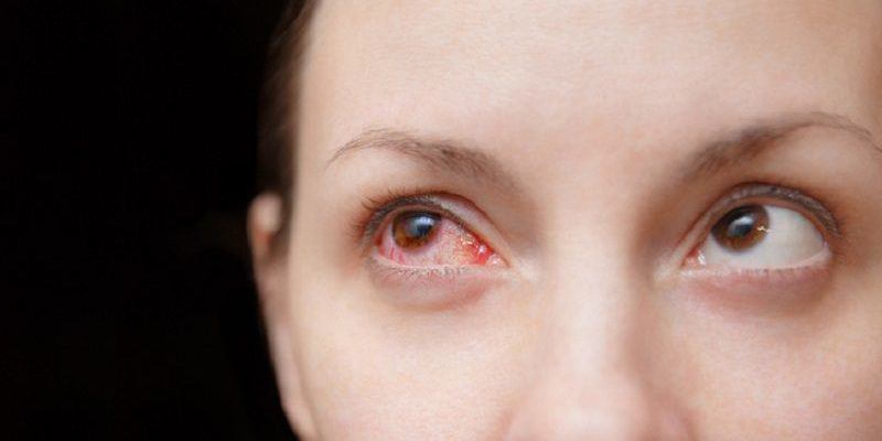 Đau mắt kiêng ăn gì? Những thực phẩm cần tránh để mắt không bị tổn thương thêm - 1