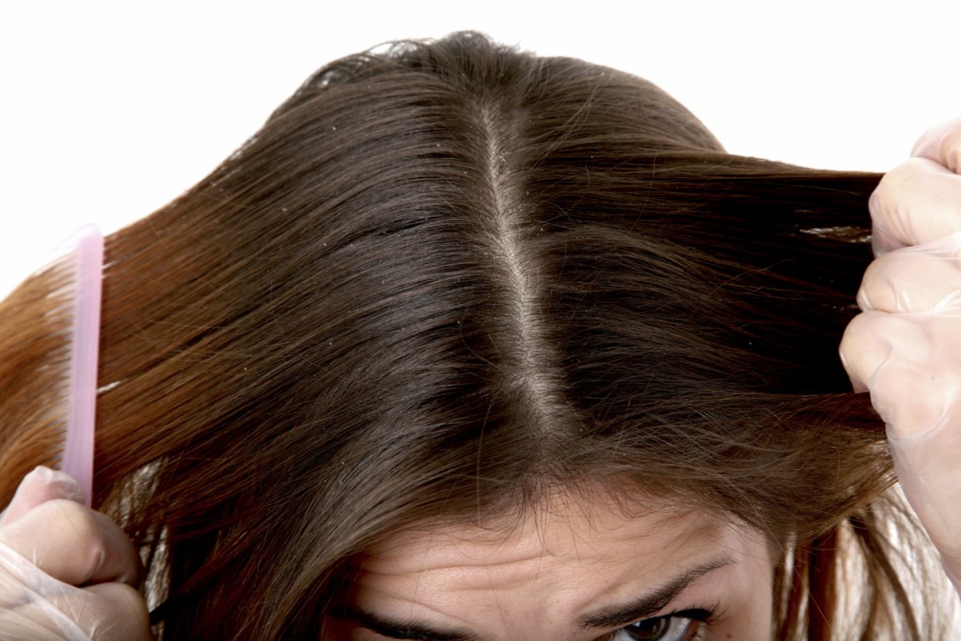 3 phương pháp giúp da đầu sạch gàu, giảm ngứa hiệu quả - 1