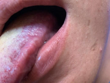 Người đàn ông trẻ tưởng bị nhiệt miệng hóa ung thư lưỡi, bác sĩ cảnh báo 2 thói quen gây ung thư