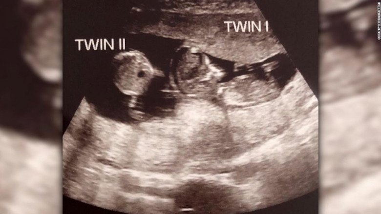Đang mang thai 3 tháng, mẹ bầu đi siêu âm tá hỏa biết có thêm 1 bé ...