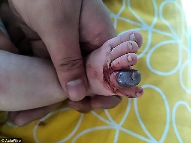 Bé trai 2 tháng tuổi đau đớn khi ngón chân bị hoại tử chỉ vì một sợi tóc rụng