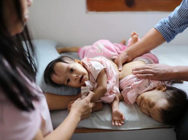 me dau don chap nhan phau thuat cho cap song sinh dinh lien du co nguy co mat 1 dua - 4