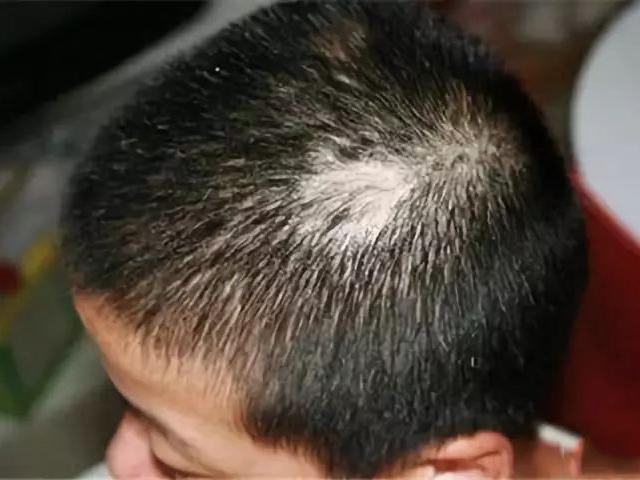 Hội chứng nghiện nhổ tóc: Dấu hiệu, ảnh hưởng và cách chữa - TÂM LÝ TRỊ  LIỆU NHC