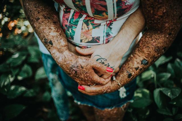 chang trai quyet yeu co gai bi huy hoai dung nhan, minh chung cho cau "tinh yeu luon ton tai" - 5